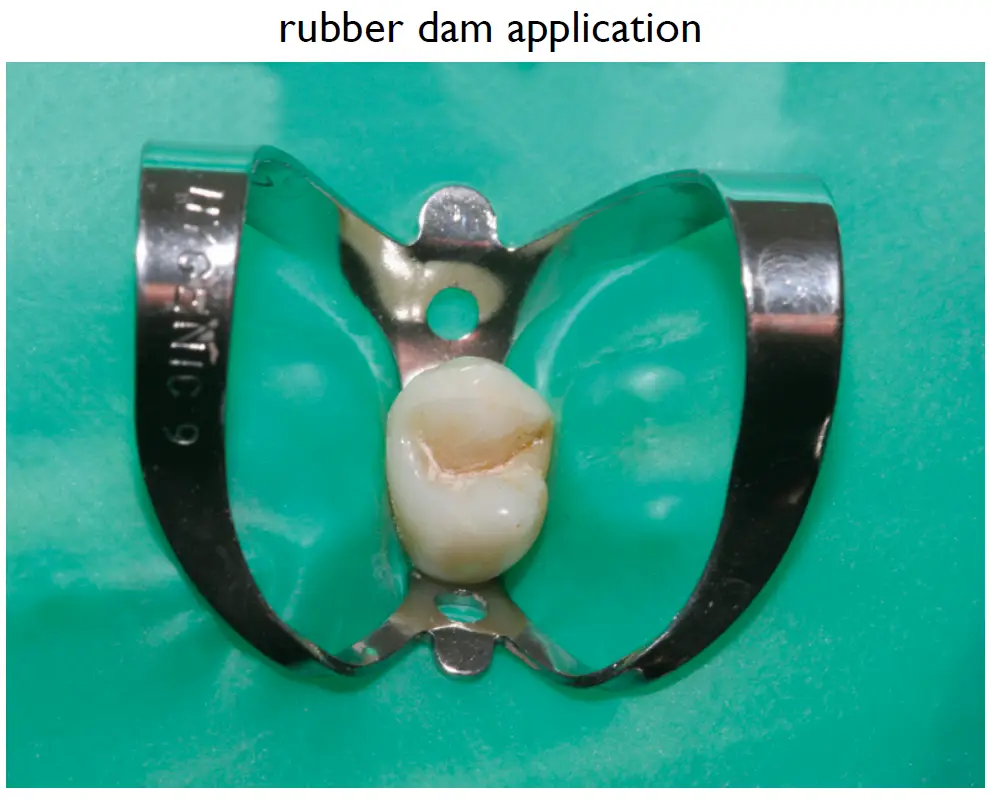 Infection Control in Endodontics (Aseptic Technique)-1765466424716.webp