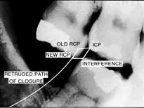 Occlusion-1780716806624.webp