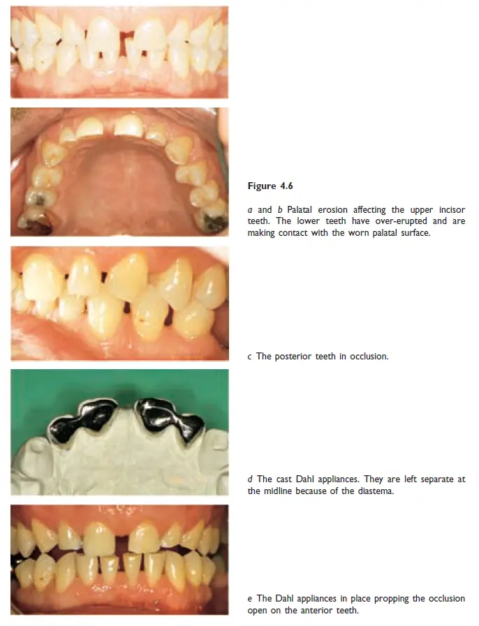 Occlusion-1780719730620.webp686