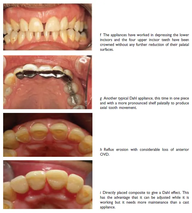 Occlusion-1780719745696.webp