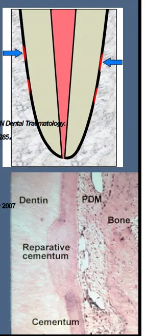 Pathological Tooth Resorption-1765494904285.webp
