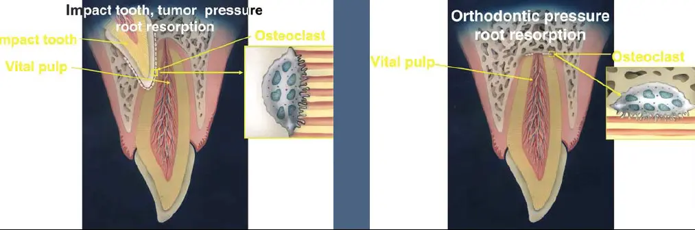 Pathological Tooth Resorption-1765495923716.webp