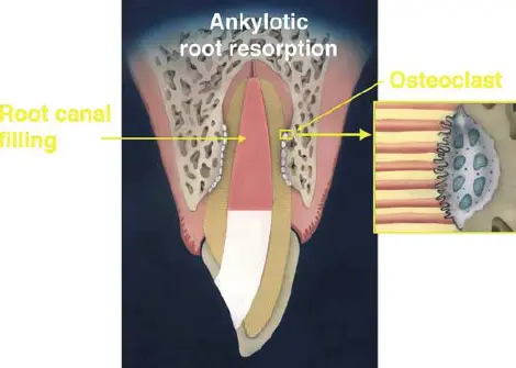 Pathological Tooth Resorption-1765496354988.webp