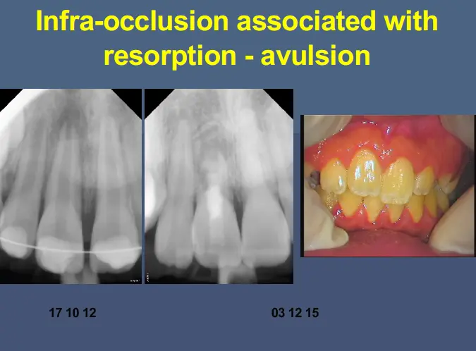 Pathological Tooth Resorption-1765515165407.webp506x373
