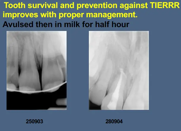 Pathological Tooth Resorption-1765515186464.webp