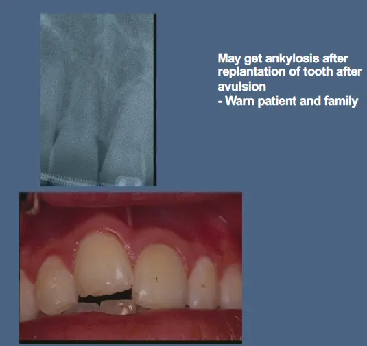 Pathological Tooth Resorption-1765516658506.webp