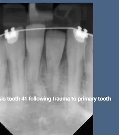 Pathological Tooth Resorption-1765516786520.webp