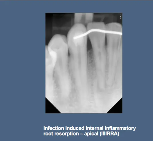 Pathological Tooth Resorption-1765516927691.webp371x343