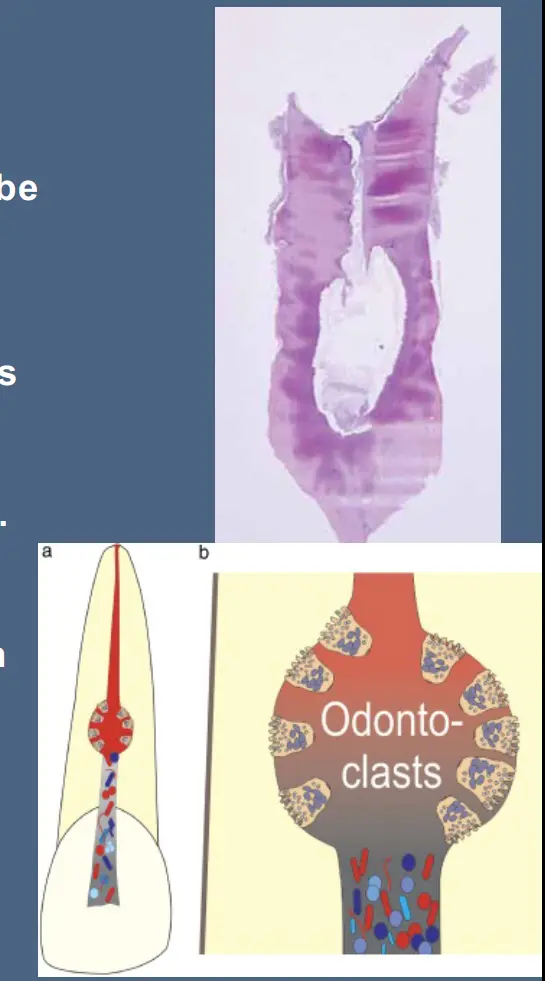 Pathological Tooth Resorption-1765517789322.webp281x506