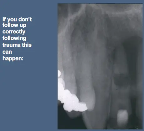 Pathological Tooth Resorption-1765518194449.webp