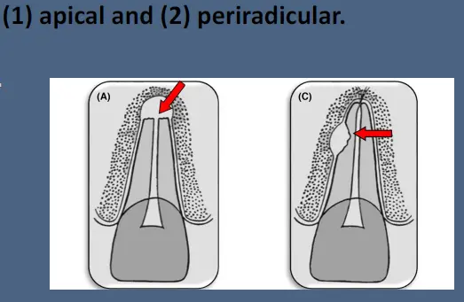 Pathological Tooth Resorption-1765518388700.webp