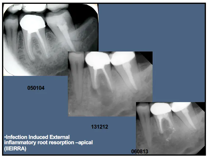 Pathological Tooth Resorption-1765518438024.webp