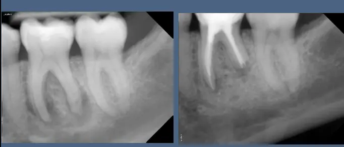 Pathological Tooth Resorption-1765518451886.webp