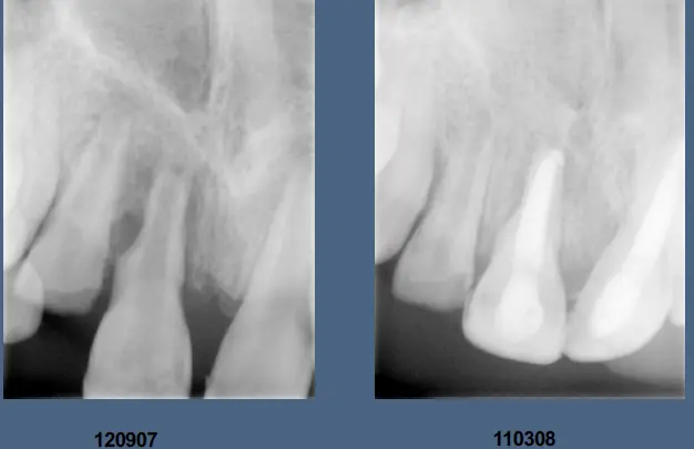 Pathological Tooth Resorption-1765518563985.webp
