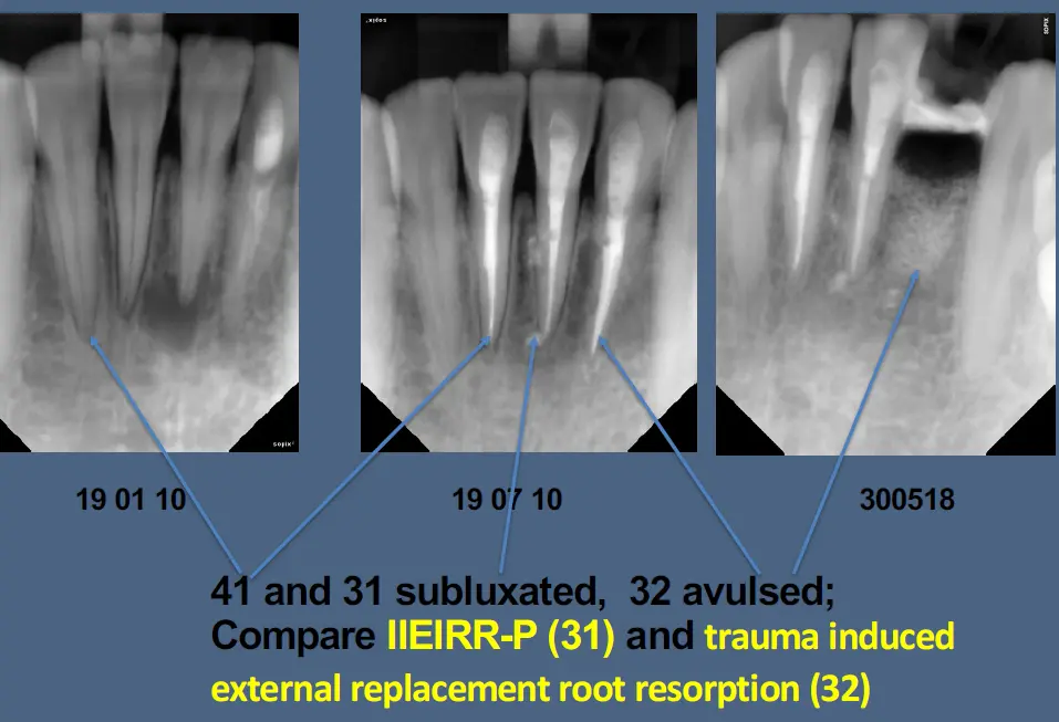 Pathological Tooth Resorption-1765518674329.webp