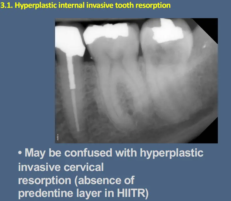 Pathological Tooth Resorption-1765518914696.webp