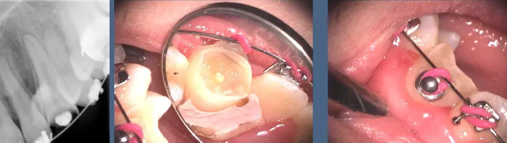 Pathological Tooth Resorption-1765519002173.webp