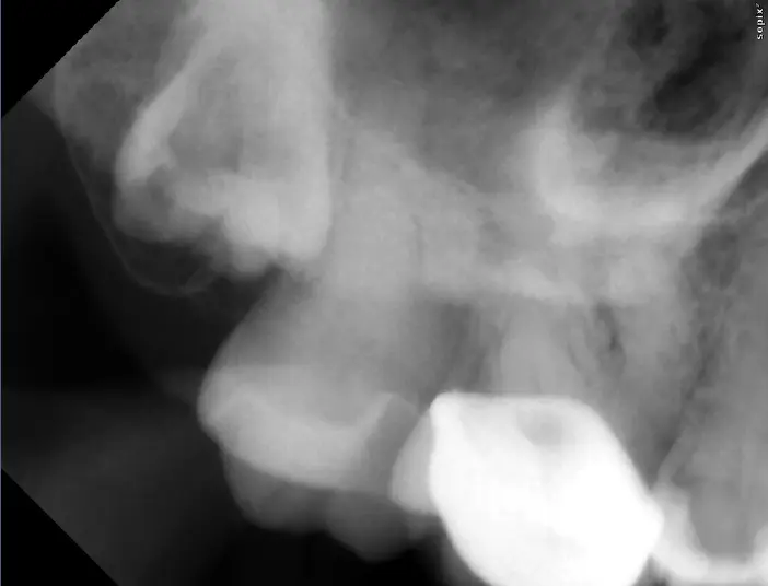 Pathological Tooth Resorption-1765519013248.webp