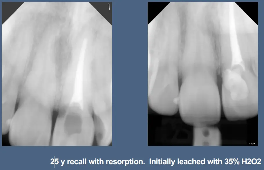 Pathological Tooth Resorption-1765519120646.webp
