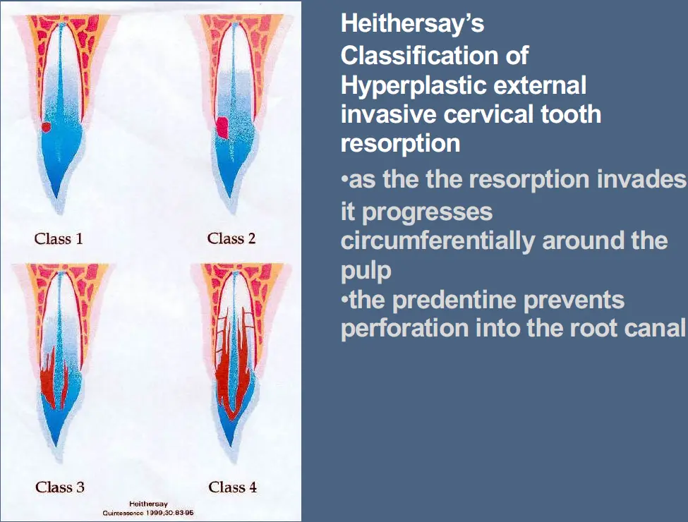 Pathological Tooth Resorption-1765522322637.webp