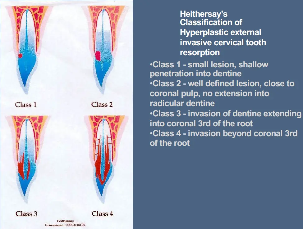 Pathological Tooth Resorption-1765522336023.webp