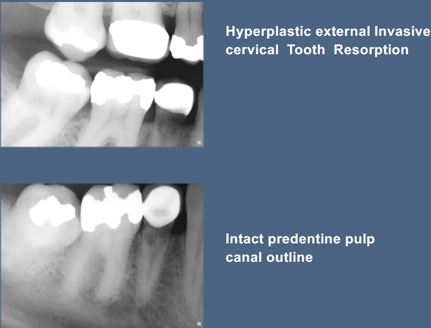 Pathological Tooth Resorption-1765522428623.webp