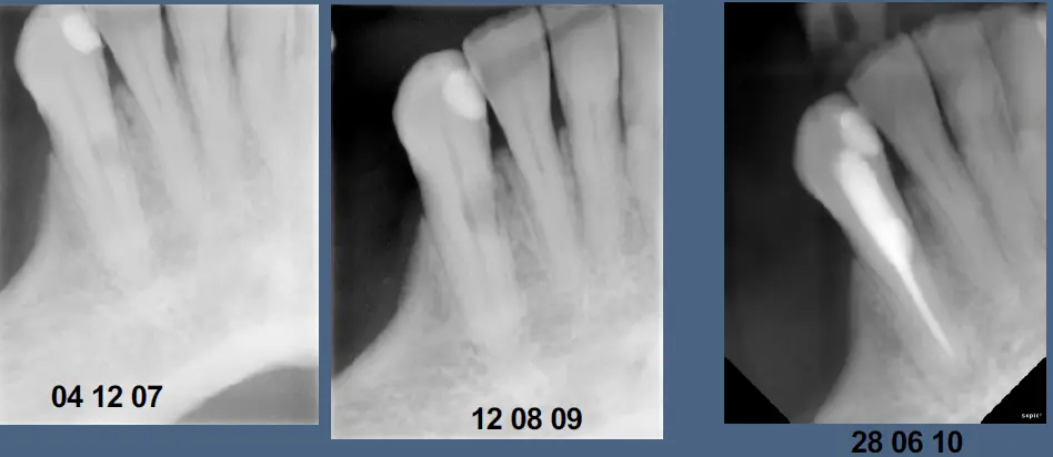 Pathological Tooth Resorption-1765522562810.webp