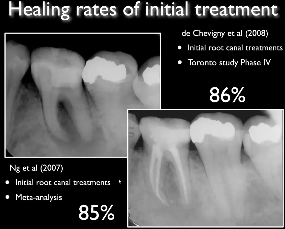 Prognosis, recall, evaluation of endodontic treatment outcomes-1765106458258.webp