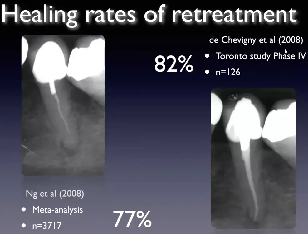 Prognosis, recall, evaluation of endodontic treatment outcomes-1765106525342.webp509x388