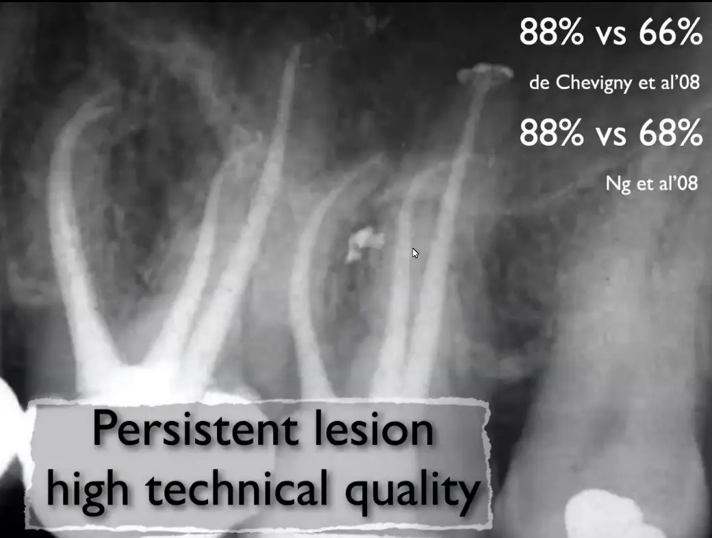Prognosis, recall, evaluation of endodontic treatment outcomes-1765106616851.webp512x387