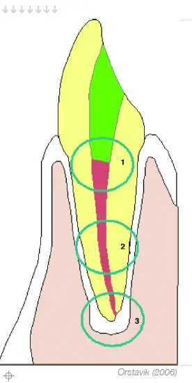 Root Canal Obturation-1764900614561.webp115x229