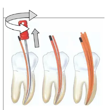 Root Canal Obturation-1764902959596.webp305x307