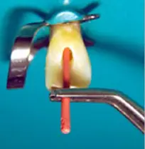 Root Canal Obturation-1764915395071.webp155x159