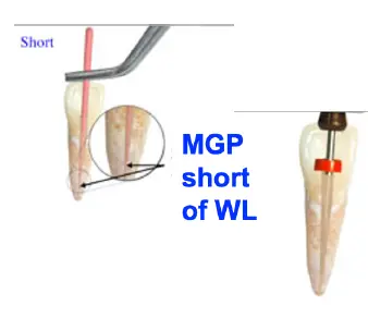 Root Canal Obturation-1764915410567.webp171x148