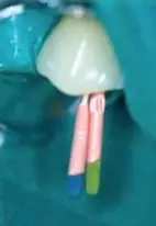 Root Canal Obturation-1764915483188.webp110x160