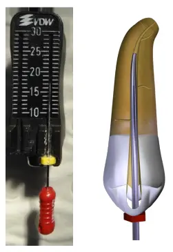 Root Canal Obturation-1764915526956.webp169x246