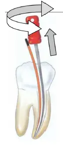Root Canal Obturation-1764915552351.webp