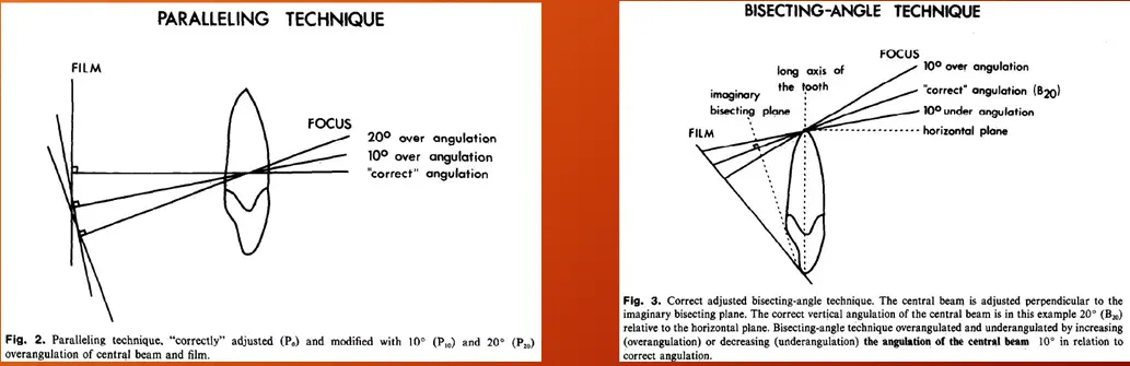 Root canal mechanical instrumentation 1, working length, glide path, hand instrumentation methods (step-back, modified crown-down)-1764890393613.webp