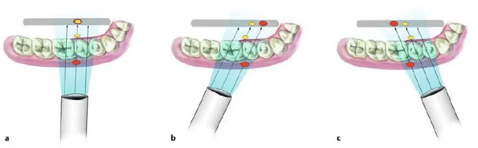 Root canal mechanical instrumentation 1, working length, glide path, hand instrumentation methods (step-back, modified crown-down)-1764890430976.webp