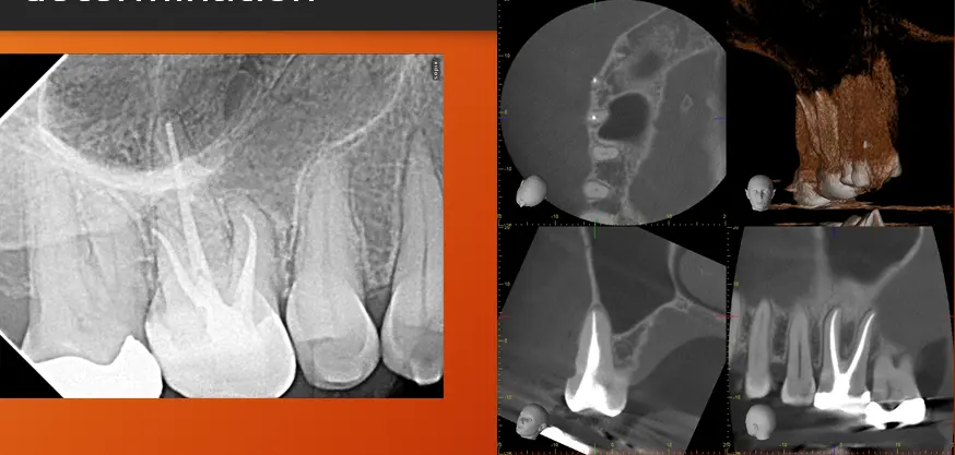 Root canal mechanical instrumentation 1, working length, glide path, hand instrumentation methods (step-back, modified crown-down)-1764890654589.webp