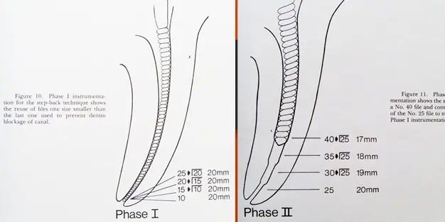 Root canal mechanical instrumentation 1, working length, glide path, hand instrumentation methods (step-back, modified crown-down)-1764891662529.webp