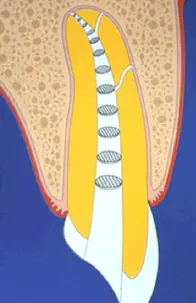 Root canal mechanical instrumentation 2, rotary canal preparation methods-1764892185735.webp