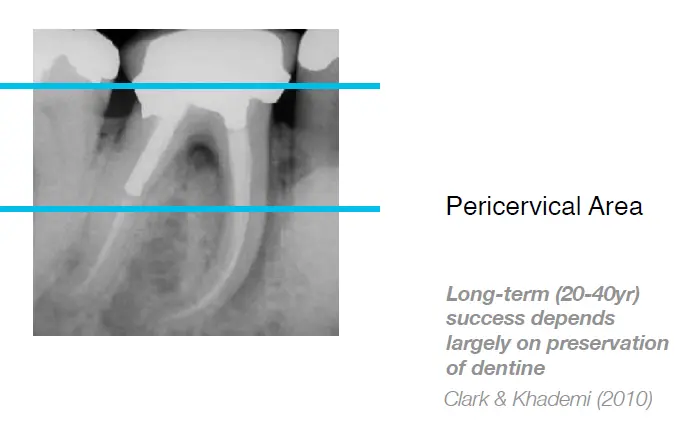 Root canal mechanical instrumentation 2, rotary canal preparation methods-1764892405293.webp