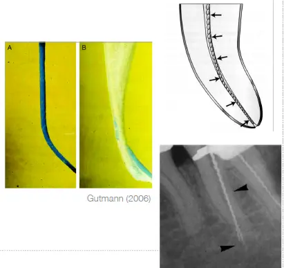 Root canal mechanical instrumentation 2, rotary canal preparation methods-1764892533474.webp