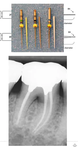 Root canal mechanical instrumentation 2, rotary canal preparation methods-1764892673201.webp