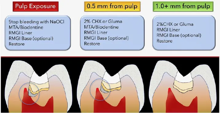 Vital Pulp Therapy-1765165522648.webp