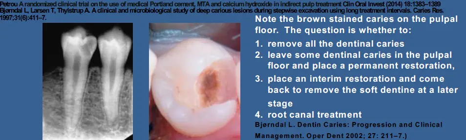 Vital Pulp Therapy-1765166894882.webp